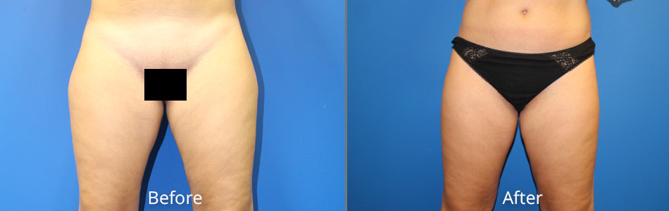 Liposuction Arms Before & After Photos Charlotte North Carolina