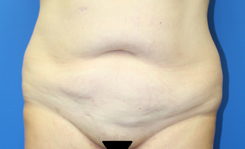 Abdominoplasty Before and After 29