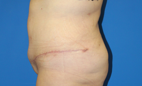Abdominoplasty Before and After 29
