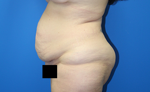 Abdominoplasty Before and After 30