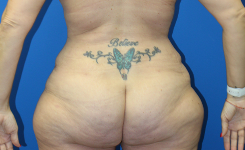 Abdominoplasty Before and After 30