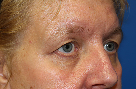 Eyelid Lift Before and After 06