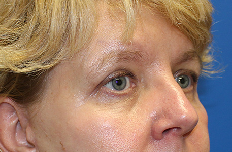 Eyelid Lift Before and After 06