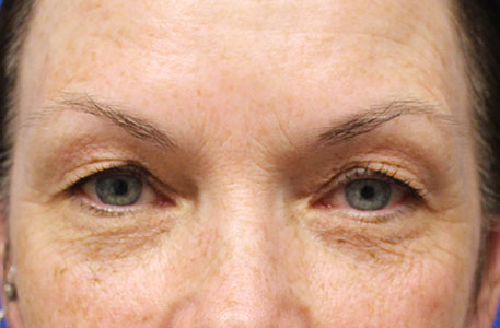 Eyelid Lift Before and After 07
