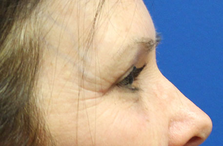 Eyelid Lift Before and After 07