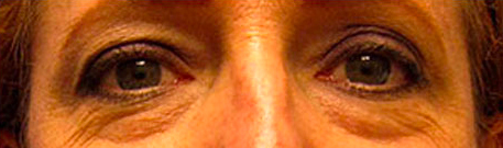 Eyelid Lift Before and After 08